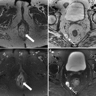 A Year Old Woman With Mucinous Tumor In The Lower Rectum Axial T Wi