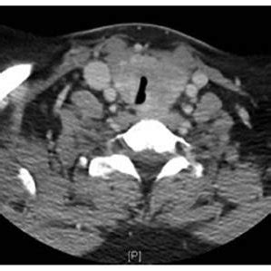 Preoperative Computed Tomography Scan Showing Significant Tracheal