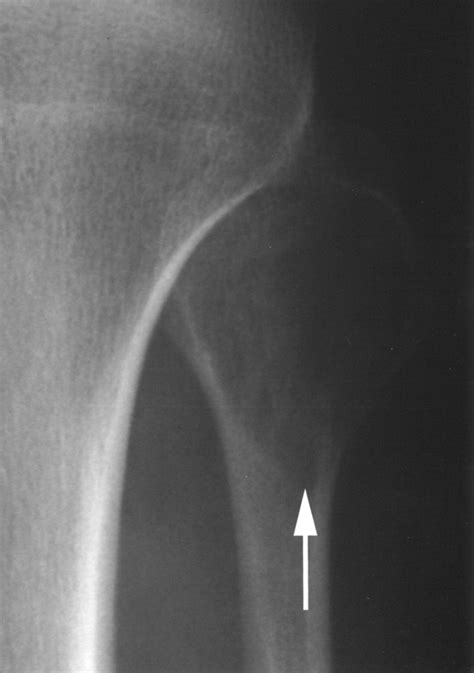 Chondroblastoma Radiology