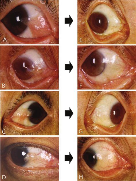 Left Column A B Limbal Conjunctival Autograft Without 0 02 Mmc C Download Scientific