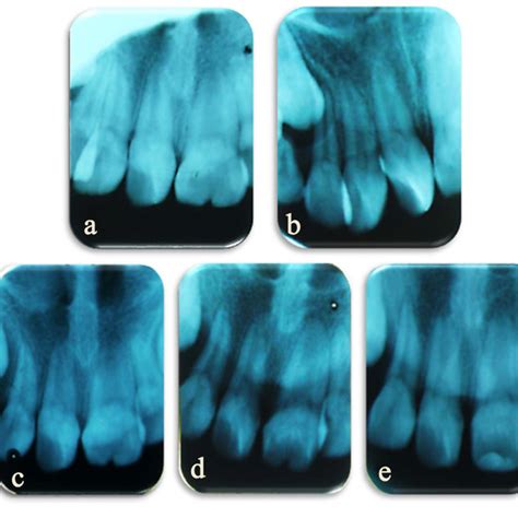 Intraoral Photographs A Pretreatment Intraoral Photograph Showing