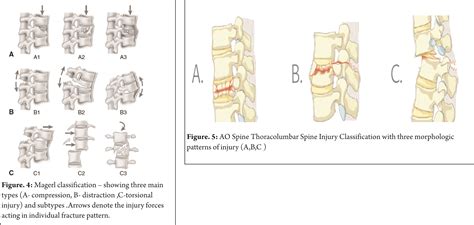 Thoracolumbar Fractures Classification And Clinical Relevance International Journal Of Spine