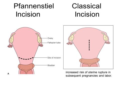 abdomenal incision on emaze