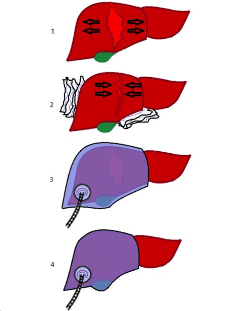 1 Liver Injury 2 Perihepatic Packing 3 Vbp Placement 4 Vbp