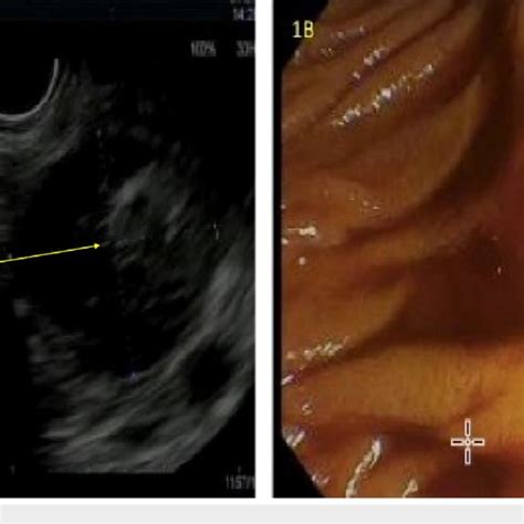 Endoscopic Images A Eus B Upper Esophagogastroduodenoscopy A