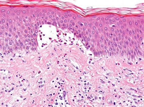 Pemphigoid Histology