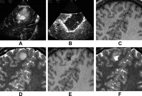 Two Dimensional High End Ultrasound Imaging Compared To Intraoperative