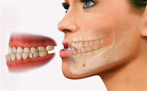 Mordida Invertida Causas Soluciones Y Tratamientos
