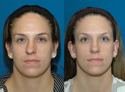 Rhinoplasty Seattle Rhinoplasty Specialist Bellevue Rhinoplasty