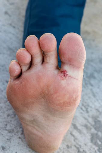 Pie De Atleta Tinea Pedis Infección Por Hongos O Planta De Los Pies Con