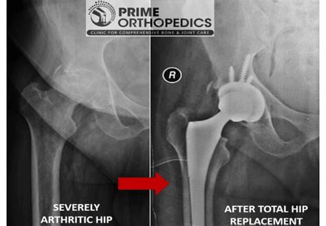 Best Hip Joint Replacement in Bangalore – Prime Orthopedics