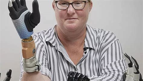 Groundbreaking Bionic Arm Could Advance Amputee Care