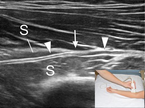 Ultrasound Of The Elbow With Emphasis On Detailed Assessment Of