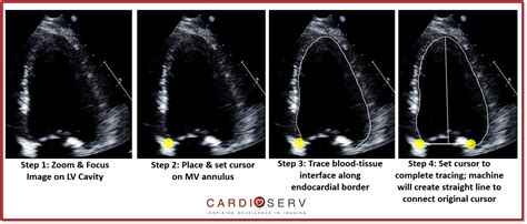 Let S Talk Left Ventricle Bi Plane Volume Measurements Cardioserv