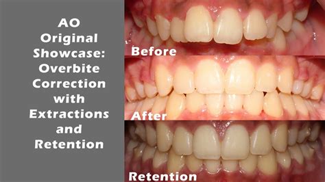 Alexandria Orthodontics Showcase Overbite Correction With Extractions