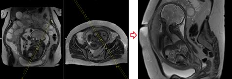 Fetal abdominal MRI | Fetal abdominal MRI protocol and planning