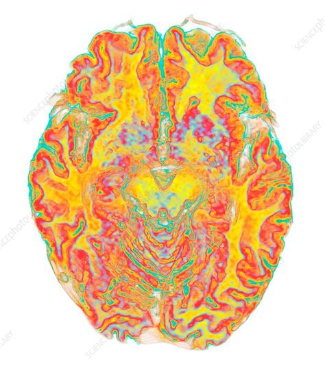 Human Brain 3d Mri Scan Stock Image C0369033 Science Photo Library