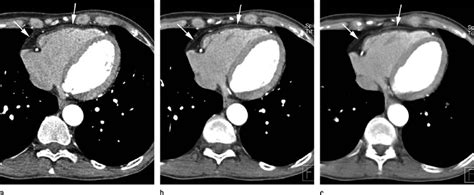 Effect of section thickness on visualization of normal pericardium ...