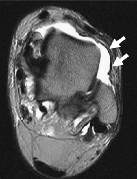 Anterior Tibiofibular Ligament Mri