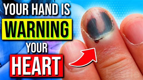 5 Heart Disease Symptoms Your Hands Can Reveal Youtube