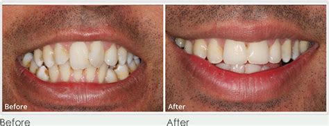 Clear Braces Essex | Invisible Braces | Perfect Smile Spa