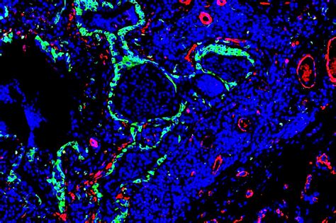 Inhalable Treatment Enhances Regeneration In Lung Fibrosis Model Uc