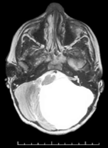 Figure 3 from Giant Posterior Fossa Arachnoid Cyst | Semantic Scholar