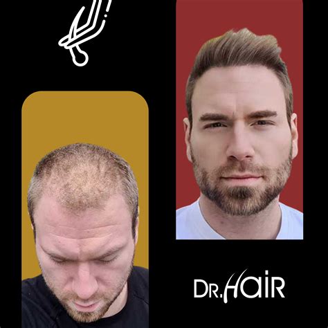 Best Hair Transplant Places In Turkey Clinicpark