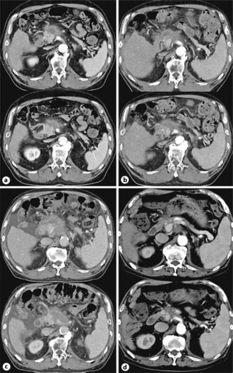 Abdominal Ct Findings Of Case 1 A Ct At Admission B Ct 8 Months After Download Scientific