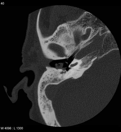 Cholesteatoma Acquired Radiology Case Radiology