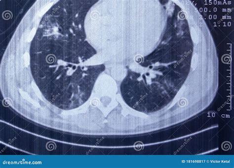 X-ray of Pneumonia-affected Lungs. CT Scan Stock Image - Image of anatomy, heart: 181698817