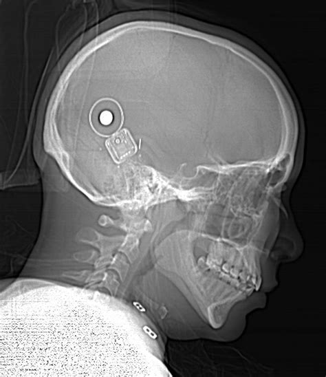 Cochlear Implant - MR IMPLANT