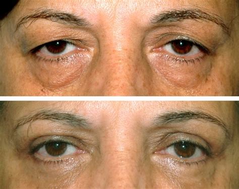 👉 Eyelid Surgery - Photos, Recovery time, Procedure, Cost (December 2021)