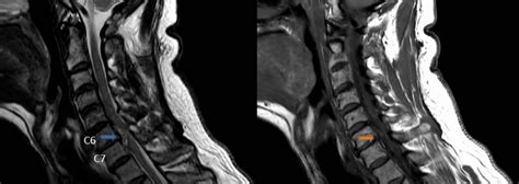 CERVICAL HERNIATED DISC - MOTUS Physical Therapy