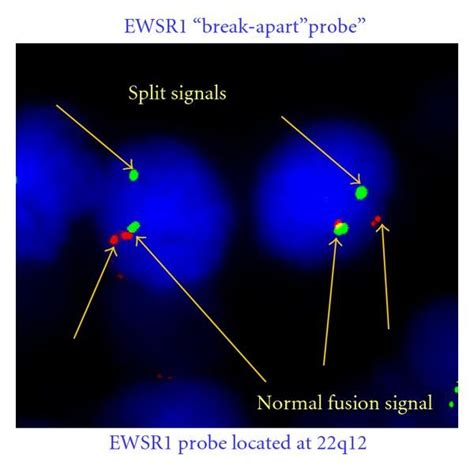 FISH Analysis Using Vysis LSI EWSR1 Dual Color Break Apart