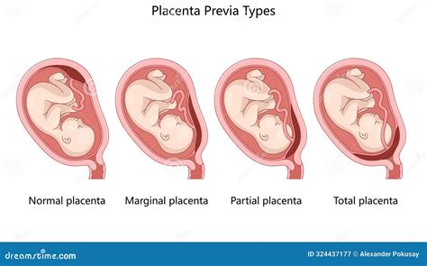 Types Of Placenta Previa Diagram Medical Science Stock Illustration Illustration Of Labeled