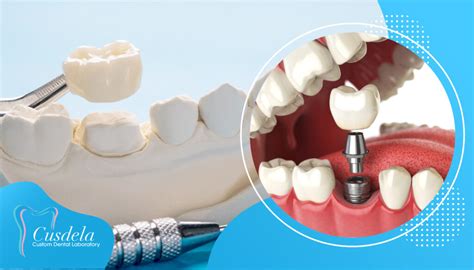 Dental Implant Vs Crown: Pros and Cons. - Blog