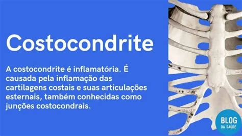 Costocondrite O Que é Causas Sintomas E Tratamentos Blog Da Saúde