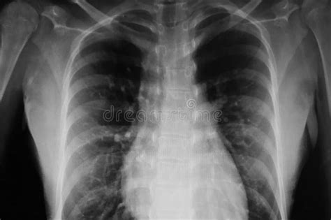 black  white torso  ray film image stock photo image  skeleton