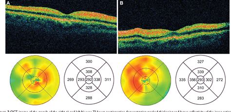 Figure 2 From Optical Coherence Tomography Findings Of Quinine