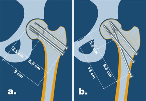 Biomechanics Of The Fractured Femoral Neck The New BDSF Method Of