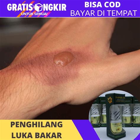 Obat Penghilang Bekas Luka Bakar Bekas Luka Bakar Menahun Buat