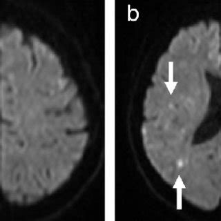 Magnetic Resonance Imaging Mri Findings On Admission A Diffusion