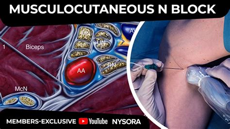 Musculocutaneous Nerve Block Taught By Dr Hadzic Members Exclusive Youtube