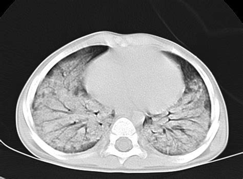 High Resolution Computed Tomography Scan Of The Chest Demonstrating