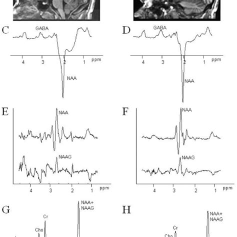 Regions Of Interest Used For Magnetic Resonance Spectroscopy Mrs