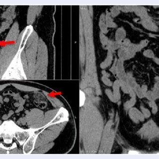 Non Enhanced Abdominal Ct Scan Of A Axial And B Coronal Lesions At