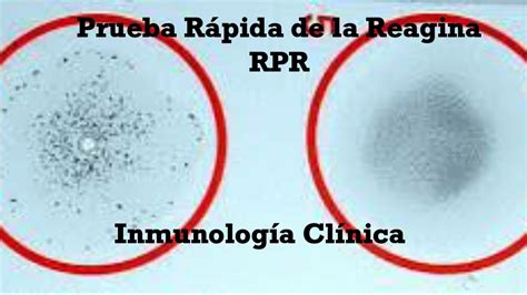 Prueba R Pida De La Reagina Rpr Youtube