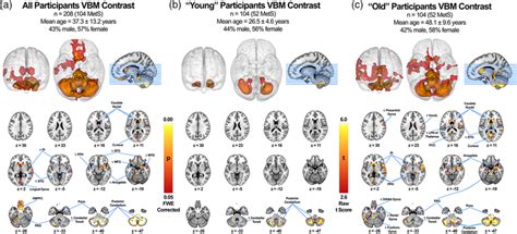 VBM Cluster Analysis Of Statistically Significant Gray Matter