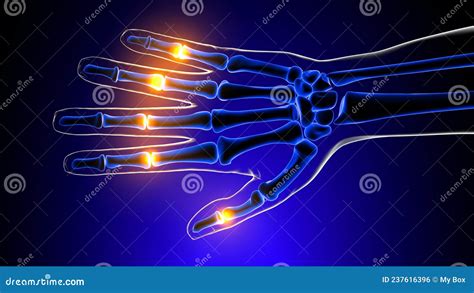 Proximal Interphalangeal Joints Pain Anatomy for Medical Concept 3D ...